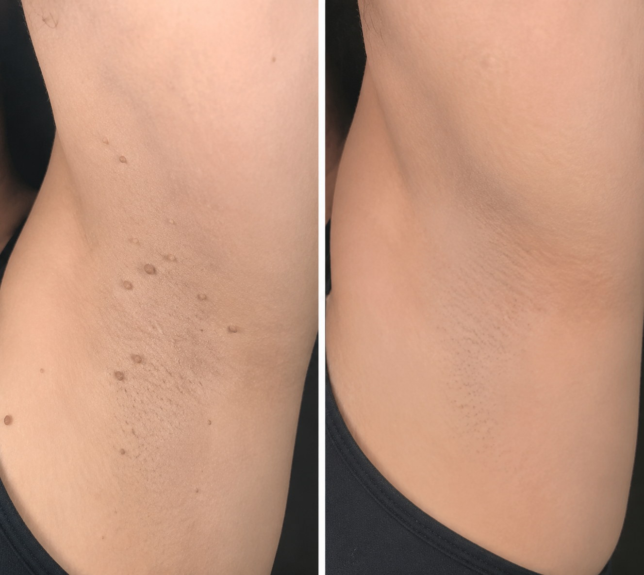 ✨Cureoskin®2-in-1 Microneedle & Hydrocolloid Patch🍀| Removes Raised Moles, Acne, Flat Warts & Skin Tags | Helps Improve Wrinkles, Scars & Blemishes | Invisible Patches for Face & Body