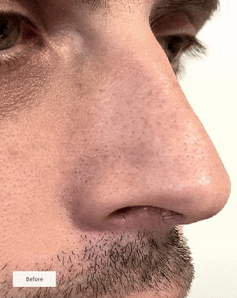 NOSE PATCHES
