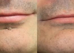 ✨Cureoskin®2-in-1 Microneedle & Hydrocolloid Patch🍀| Removes Raised Moles, Acne, Flat Warts & Skin Tags | Helps Improve Wrinkles, Scars & Blemishes | Invisible Patches for Face & Body
