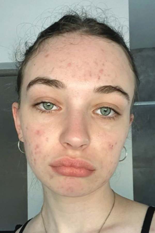Before - Melissa W.