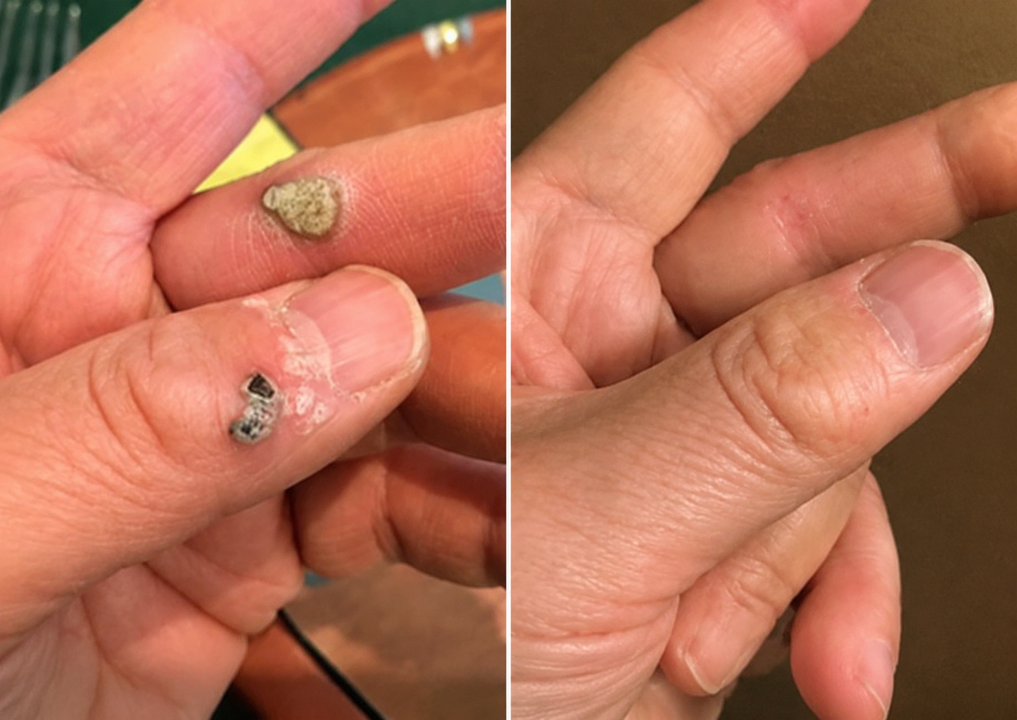 ✨Cureoskin®2-in-1 Microneedle & Hydrocolloid Patch🍀| Removes Raised Moles, Acne, Flat Warts & Skin Tags | Helps Improve Wrinkles, Scars & Blemishes | Invisible Patches for Face & Body